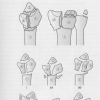 Переломы дистального метаэпифиза лучевой кости: со смещением и без смещения Перелом лучевой кости правой руки